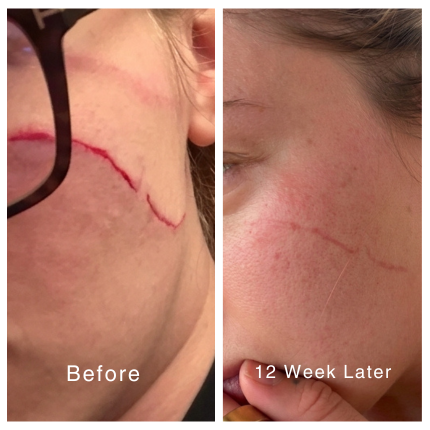 Smooth Your Scars — Just 60 Seconds a Day